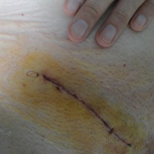 The incision, stained with iodine, two days later